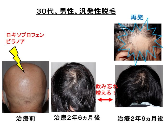 円形脱毛症　病院